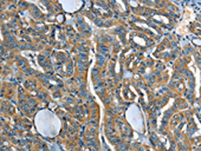 The image on the left is immunohistochemistry of paraffin-embedded Human thyroid cancer tissue using CSB-PA249707(ADCY4 Antibody) at dilution 1/45, on the right is treated with fusion protein. (Original magnification: ×200)