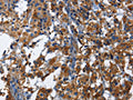The image on the left is immunohistochemistry of paraffin-embedded Human thyroid cancer tissue using CSB-PA249906(KLRB1 Antibody) at dilution 1/40, on the right is treated with fusion protein. (Original magnification: ×200)