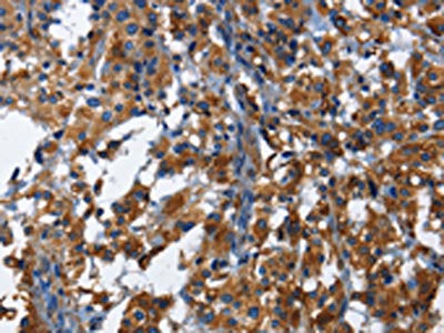 The image on the left is immunohistochemistry of paraffin-embedded Human thyroid cancer tissue using CSB-PA249906(KLRB1 Antibody) at dilution 1/40, on the right is treated with fusion protein. (Original magnification: ×200)
