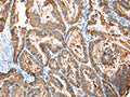 The image on the left is immunohistochemistry of paraffin-embedded Human esophagus cancer tissue using CSB-PA250029(CXCR4 Antibody) at dilution 1/20, on the right is treated with synthetic peptide. (Original magnification: ×200)