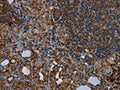The image on the left is immunohistochemistry of paraffin-embedded Human thyroid cancer tissue using CSB-PA250156(HMGCL Antibody) at dilution 1/20, on the right is treated with fusion protein. (Original magnification: ×200)