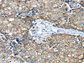 The image on the left is immunohistochemistry of paraffin-embedded Human gastic cancer tissue using CSB-PA250552(IFNA2 Antibody) at dilution 1/40, on the right is treated with synthetic peptide. (Original magnification: ×200)