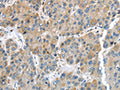 The image on the left is immunohistochemistry of paraffin-embedded Human liver cancer tissue using CSB-PA250918(IGFBP4 Antibody) at dilution 1/35, on the right is treated with fusion protein. (Original magnification: ×200)