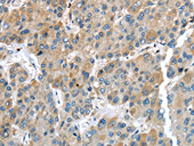 The image on the left is immunohistochemistry of paraffin-embedded Human liver cancer tissue using CSB-PA250918(IGFBP4 Antibody) at dilution 1/35, on the right is treated with fusion protein. (Original magnification: ×200)