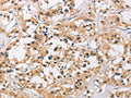 The image on the left is immunohistochemistry of paraffin-embedded Human thyroid cancer tissue using CSB-PA251074(C3AR1 Antibody) at dilution 1/50, on the right is treated with fusion protein. (Original magnification: x200)