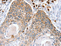 The image on the left is immunohistochemistry of paraffin-embedded Human esophagus cancer tissue using CSB-PA251137(RNF185 Antibody) at dilution 1/20, on the right is treated with fusion protein. (Original magnification: ×200)