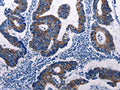 The image on the left is immunohistochemistry of paraffin-embedded Human colon cancer tissue using CSB-PA251438(DUSP6 Antibody) at dilution 1/50, on the right is treated with fusion protein. (Original magnification: ×200)