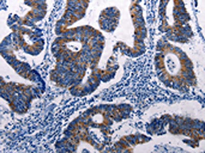 The image on the left is immunohistochemistry of paraffin-embedded Human colon cancer tissue using CSB-PA251438(DUSP6 Antibody) at dilution 1/50, on the right is treated with fusion protein. (Original magnification: ×200)