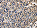 The image on the left is immunohistochemistry of paraffin-embedded Human liver cancer tissue using CSB-PA251527(AFP Antibody) at dilution 1/50, on the right is treated with fusion protein. (Original magnification: ×200)