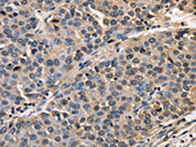 The image on the left is immunohistochemistry of paraffin-embedded Human liver cancer tissue using CSB-PA251527(AFP Antibody) at dilution 1/50, on the right is treated with fusion protein. (Original magnification: ×200)