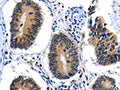 The image on the left is immunohistochemistry of paraffin-embedded Human colon cancer tissue using CSB-PA251962(CEBPG Antibody) at dilution 1/25, on the right is treated with fusion protein. (Original magnification: ×200)
