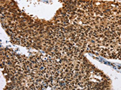 The image on the left is immunohistochemistry of paraffin-embedded Human lung cancer tissue using CSB-PA252158(ELAVL1 Antibody) at dilution 1/40, on the right is treated with fusion protein. (Original magnification: ×200)
