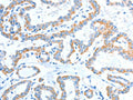 The image on the left is immunohistochemistry of paraffin-embedded Human thyroid cancer tissue using CSB-PA252519(ADAM2 Antibody) at dilution 1/15, on the right is treated with fusion protein. (Original magnification: ×200)