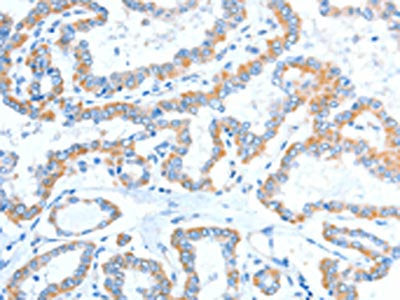 The image on the left is immunohistochemistry of paraffin-embedded Human thyroid cancer tissue using CSB-PA252519(ADAM2 Antibody) at dilution 1/15, on the right is treated with fusion protein. (Original magnification: ×200)