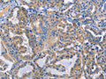 The image on the left is immunohistochemistry of paraffin-embedded Human thyroid cancer tissue using CSB-PA252610(DOK4 Antibody) at dilution 1/50, on the right is treated with fusion protein. (Original magnification: ×200)