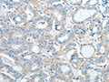 The image on the left is immunohistochemistry of paraffin-embedded Human thyroid cancer tissue using CSB-PA252711(AGBL2 Antibody) at dilution 1/25, on the right is treated with fusion protein. (Original magnification: ×200)