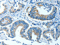 The image on the left is immunohistochemistry of paraffin-embedded Human colon cancer tissue using CSB-PA252846(ALDH4A1 Antibody) at dilution 1/35, on the right is treated with fusion protein. (Original magnification: ×200)