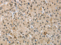 The image on the left is immunohistochemistry of paraffin-embedded Human liver cancer tissue using CSB-PA252963(NAPSA Antibody) at dilution 1/50, on the right is treated with fusion protein. (Original magnification: ×200)