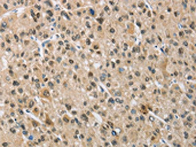 The image on the left is immunohistochemistry of paraffin-embedded Human liver cancer tissue using CSB-PA252963(NAPSA Antibody) at dilution 1/50, on the right is treated with fusion protein. (Original magnification: ×200)