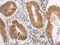 The image on the left is immunohistochemistry of paraffin-embedded Human colon cancer tissue using CSB-PA252995(PSMD3 Antibody) at dilution 1/25, on the right is treated with fusion protein. (Original magnification: ×200)