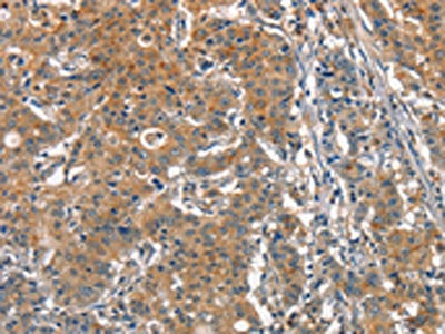 The image on the left is immunohistochemistry of paraffin-embedded Human gastic cancer tissue using CSB-PA253255(ACPT Antibody) at dilution 1/25, on the right is treated with synthetic peptide. (Original magnification: ×200)