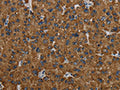 The image on the left is immunohistochemistry of paraffin-embedded Human liver cancer tissue using CSB-PA253485(PCK2 Antibody) at dilution 1/60, on the right is treated with fusion protein. (Original magnification: ×200)