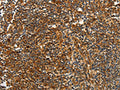 The image on the left is immunohistochemistry of paraffin-embedded Human tonsil tissue using CSB-PA254306(CNNM3 Antibody) at dilution 1/40, on the right is treated with fusion protein. (Original magnification: ×200)