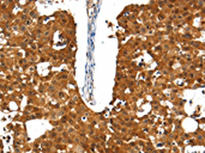 The image on the left is immunohistochemistry of paraffin-embedded Human breast cancer tissue using CSB-PA254587(SSTR5 Antibody) at dilution 1/30, on the right is treated with synthetic peptide. (Original magnification: ×200)