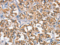 The image on the left is immunohistochemistry of paraffin-embedded Human thyroid cancer tissue using CSB-PA254609(HGF Antibody) at dilution 1/65, on the right is treated with fusion protein. (Original magnification: ×200)