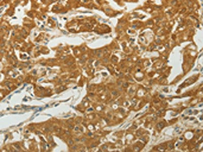 The image on the left is immunohistochemistry of paraffin-embedded Human ovarian cancer tissue using CSB-PA254627(MC4R Antibody) at dilution 1/50, on the right is treated with synthetic peptide. (Original magnification: ×200)