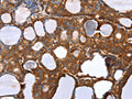 The image on the left is immunohistochemistry of paraffin-embedded Human thyroid cancer tissue using CSB-PA254703(RNF11 Antibody) at dilution 1/20, on the right is treated with fusion protein. (Original magnification: ×200)