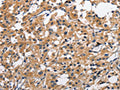 The image on the left is immunohistochemistry of paraffin-embedded Human thyroid cancer tissue using CSB-PA254797(CLEC2D Antibody) at dilution 1/70, on the right is treated with fusion protein. (Original magnification: ×200)