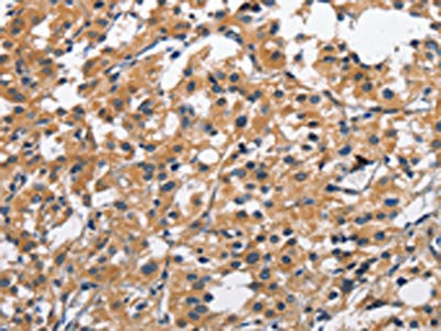 The image on the left is immunohistochemistry of paraffin-embedded Human thyroid cancer tissue using CSB-PA254797(CLEC2D Antibody) at dilution 1/70, on the right is treated with fusion protein. (Original magnification: ×200)