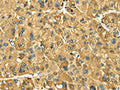 The image on the left is immunohistochemistry of paraffin-embedded Human liver cancer tissue using CSB-PA255218(LEP Antibody) at dilution 1/20, on the right is treated with fusion protein. (Original magnification: ×200)