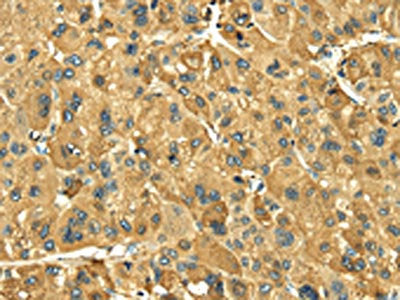 The image on the left is immunohistochemistry of paraffin-embedded Human liver cancer tissue using CSB-PA255218(LEP Antibody) at dilution 1/20, on the right is treated with fusion protein. (Original magnification: ×200)