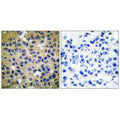 Immunohistochemical analysis of paraffin-embedded human breast carcinoma tissue using Collagen II antibody.