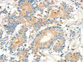 The image on the left is immunohistochemistry of paraffin-embedded Human colon cancer tissue using CSB-PA255651(MMP9 Antibody) at dilution 1/20, on the right is treated with fusion protein. (Original magnification: ×200)