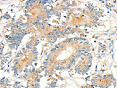 The image on the left is immunohistochemistry of paraffin-embedded Human colon cancer tissue using CSB-PA255651(MMP9 Antibody) at dilution 1/20, on the right is treated with fusion protein. (Original magnification: ×200)
