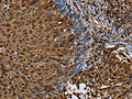 The image on the left is immunohistochemistry of paraffin-embedded Human cervical cancer tissue using CSB-PA255815(NRP2 Antibody) at dilution 1/45, on the right is treated with synthetic peptide. (Original magnification: ×200)