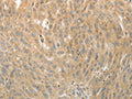 The image on the left is immunohistochemistry of paraffin-embedded Human ovarian cancer tissue using CSB-PA256025(MAP4 Antibody) at dilution 1/10, on the right is treated with fusion protein. (Original magnification: ×200)