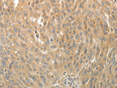 The image on the left is immunohistochemistry of paraffin-embedded Human ovarian cancer tissue using CSB-PA256025(MAP4 Antibody) at dilution 1/10, on the right is treated with fusion protein. (Original magnification: ×200)
