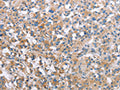 The image on the left is immunohistochemistry of paraffin-embedded Human thyroid cancer tissue using CSB-PA256752(MCL1 Antibody) at dilution 1/60, on the right is treated with synthetic peptide. (Original magnification: ×200)