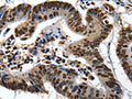 The image on the left is immunohistochemistry of paraffin-embedded Human colon cancer tissue using CSB-PA257066(XRCC6 Antibody) at dilution 1/10, on the right is treated with fusion protein. (Original magnification: ×200)