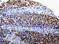 The image is immunohistochemistry of paraffin-embedded Human renal cancer tissue using CSB-PA257877(COX10 Antibody) at dilution 1/100. (Original magnification: 200)