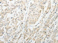 The image on the left is immunohistochemistry of paraffin-embedded Human breast cancer tissue using CSB-PA257995(AGBL1 Antibody) at dilution 1/15, on the right is treated with synthetic peptide. (Original magnification: ×200)
