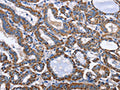 The image on the left is immunohistochemistry of paraffin-embedded Human thyroid cancer tissue using CSB-PA258120(INTS10 Antibody) at dilution 1/50, on the right is treated with fusion protein. (Original magnification: ×200)