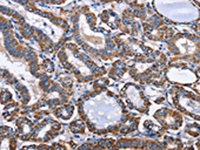 The image on the left is immunohistochemistry of paraffin-embedded Human thyroid cancer tissue using CSB-PA258120(INTS10 Antibody) at dilution 1/50, on the right is treated with fusion protein. (Original magnification: ×200)