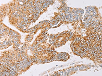 The image on the left is immunohistochemistry of paraffin-embedded Human colon cancer tissue using CSB-PA258399(YARS2 Antibody) at dilution 1/30, on the right is treated with fusion protein. (Original magnification: ×200)