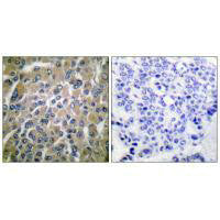 Immunohistochemical analysis of paraffin-embedded human breast carcinoma tissue using hCG β antibody.
