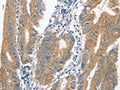 The image on the left is immunohistochemistry of paraffin-embedded Human colon cancer tissue using CSB-PA258870(CENPC Antibody) at dilution 1/70, on the right is treated with fusion protein. (Original magnification: ×200)
